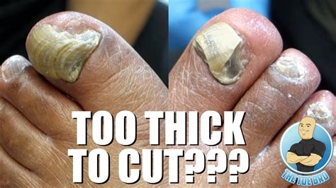 the thickness of an toenail uses what unit of measurement|crusty toenails.